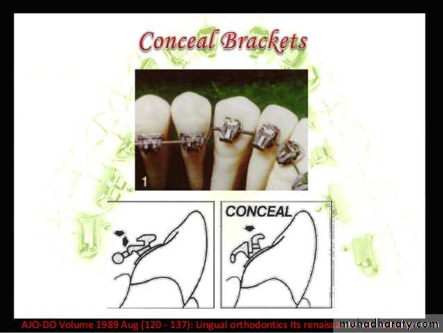lingual orthodontic