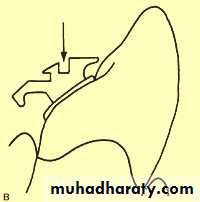 lingual orthodontic