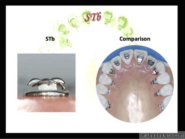 lingual orthodontic