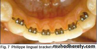 lingual orthodontic