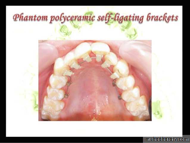 lingual orthodontic