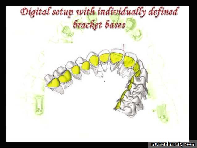 lingual orthodontic