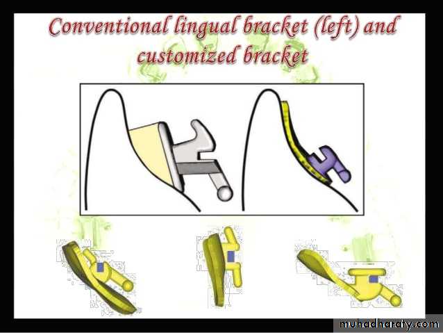lingual orthodontic