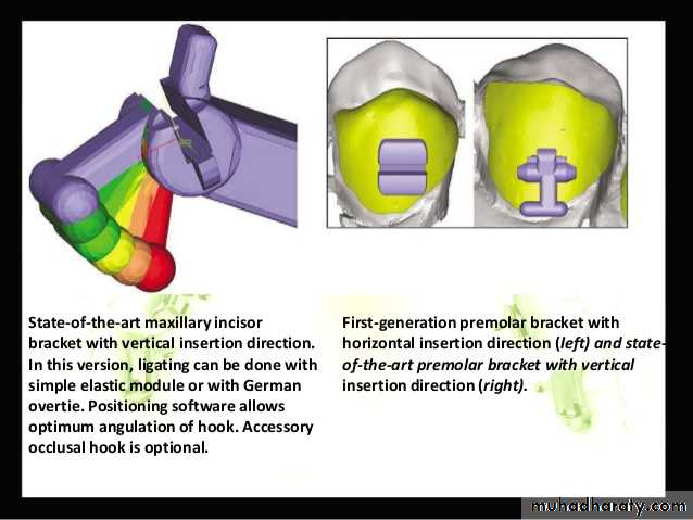 lingual orthodontic