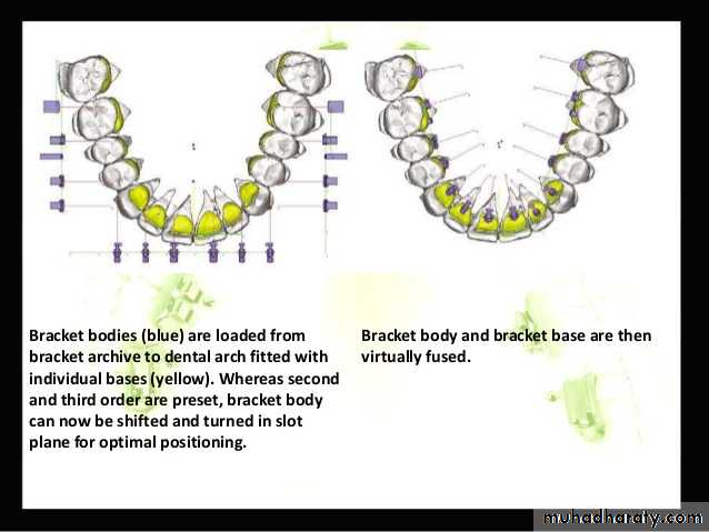 lingual orthodontic