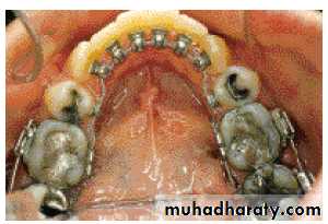 lingual orthodontic