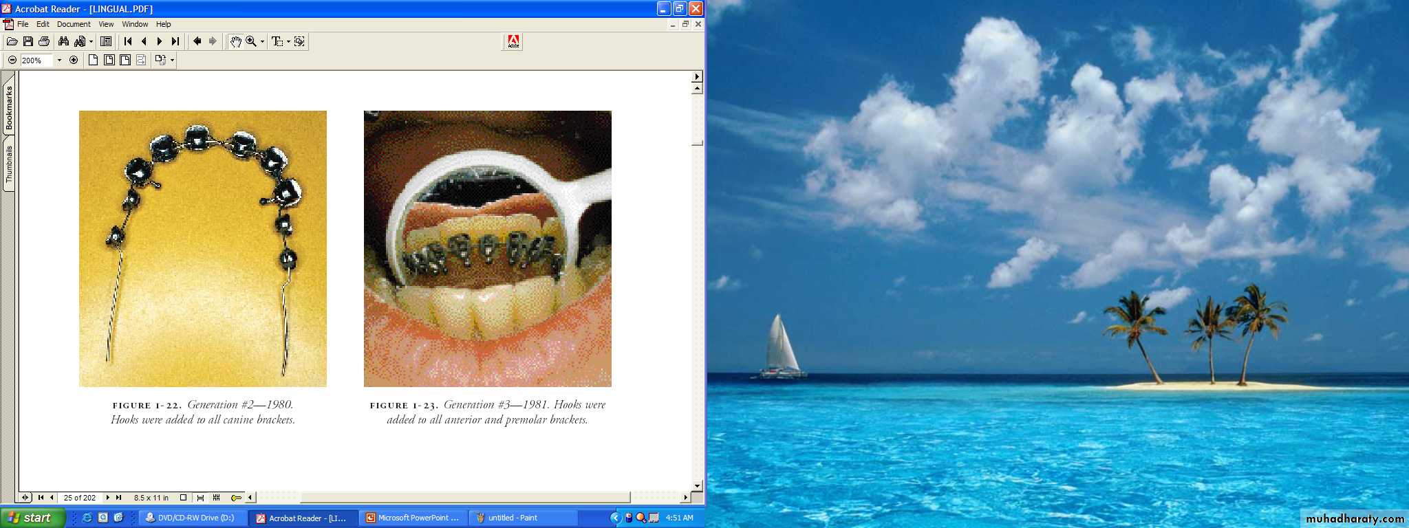 lingual orthodontic
