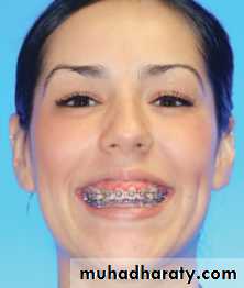 adult orthodontics LEC