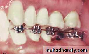 adult orthodontics LEC