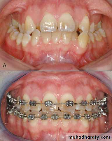 adult orthodontics LEC