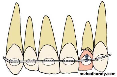 adult orthodontics LEC