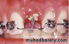 adult orthodontics LEC