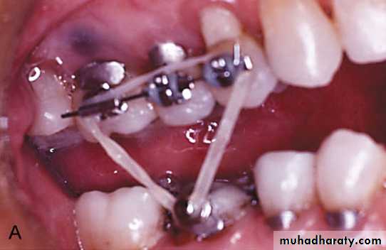 adult orthodontics LEC