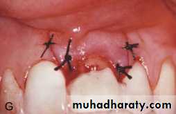 adult orthodontics LEC