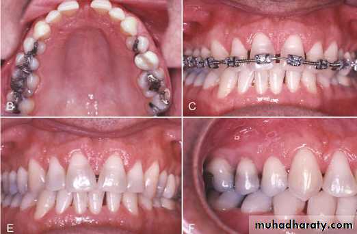 adult orthodontics LEC