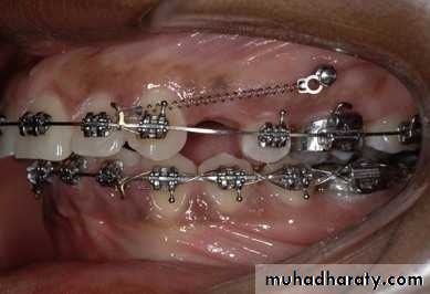 adult orthodontics LEC