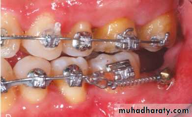 adult orthodontics LEC
