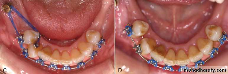 adult orthodontics LEC