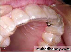 adult orthodontics LEC