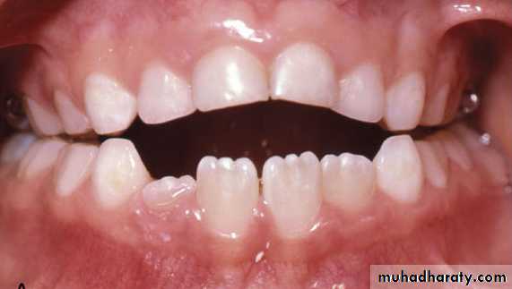 posterior crossbite