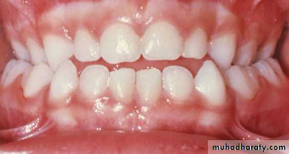 posterior crossbite