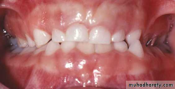posterior crossbite