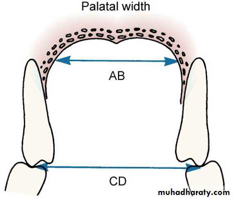posterior crossbite