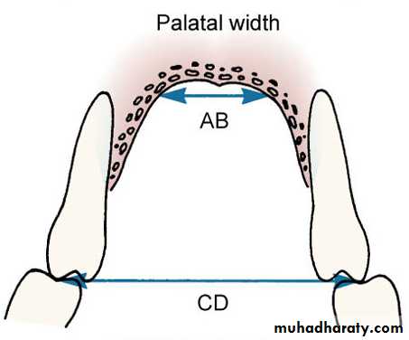 posterior crossbite