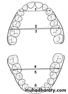 posterior crossbite