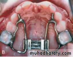 posterior crossbite