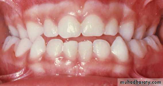 posterior crossbite