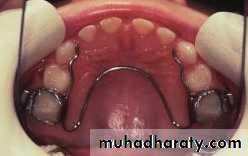 posterior crossbite