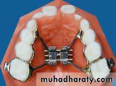 posterior crossbite