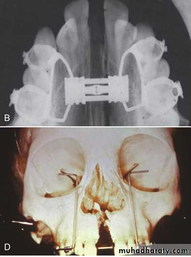 posterior crossbite