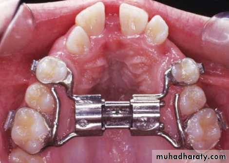 posterior crossbite