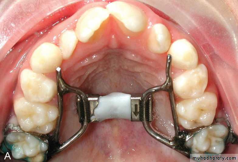 posterior crossbite