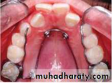 posterior crossbite