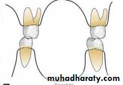 posterior crossbite