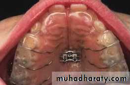 posterior crossbite