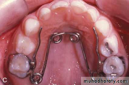 posterior crossbite