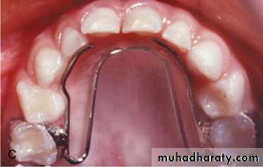 posterior crossbite