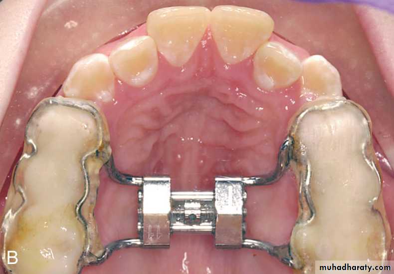 posterior crossbite