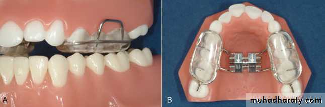 posterior crossbite