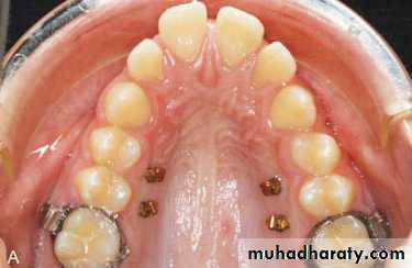 posterior crossbite