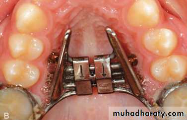 posterior crossbite