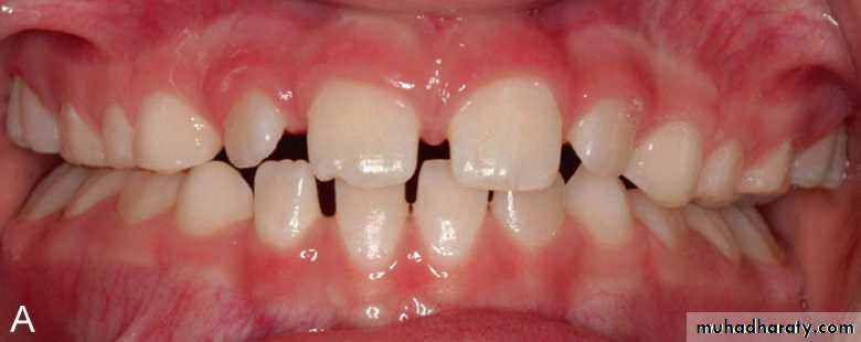 posterior crossbite