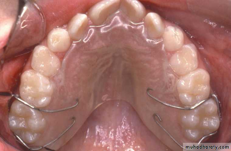 posterior crossbite