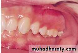 posterior crossbite
