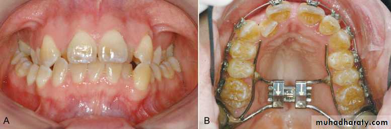 posterior crossbite