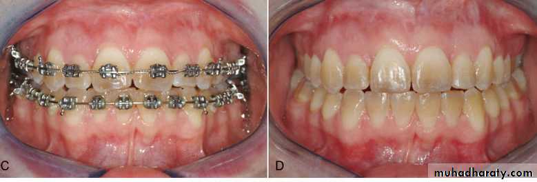 posterior crossbite